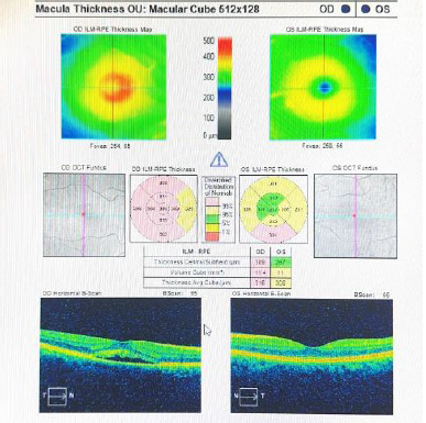 Uncommon Therapeutic Approaches for Patients with Recurrent Central Serous Chorioretinopathy: case report and literature review.