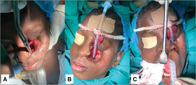 Role of Local Flaps in the Reconstruction of Extensive Anterolateral Noma Defect: A Case Report.