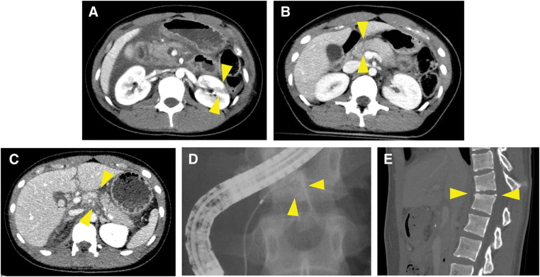 Middle Pancreatectomy for Traumatic Main Pancreatic Duct Injury with Delayed Presentation: Two Case Series.