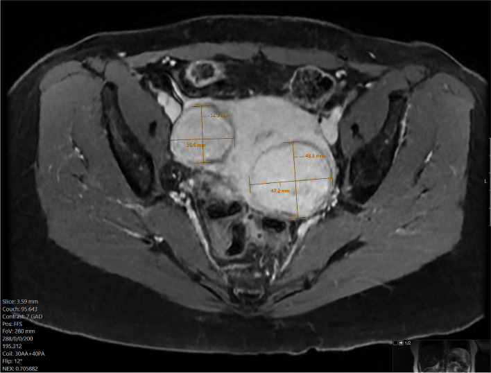 Novel pain management strategy for uterine fibroid embolization.