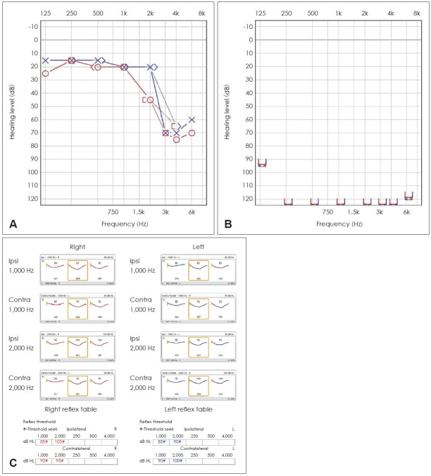 A Case of Bilateral Sudden Deafness Caused by Wernicke Encephalopathy.