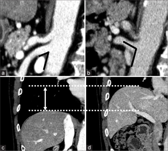 Aortomesenteric angle: A contrast-enhanced computed tomography analysis of respiratory phase and visceral fat impact.