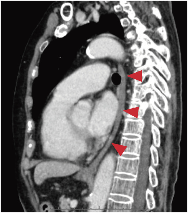 Esophageal Atresia Caused by Corrosive Esophagitis for over 50 Years: A Case Report.