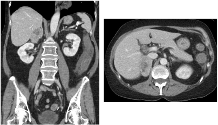 A Case of Severe Cushing Syndrome due to Metastatic Adrenocortical Carcinoma Treated With Osilodrostat