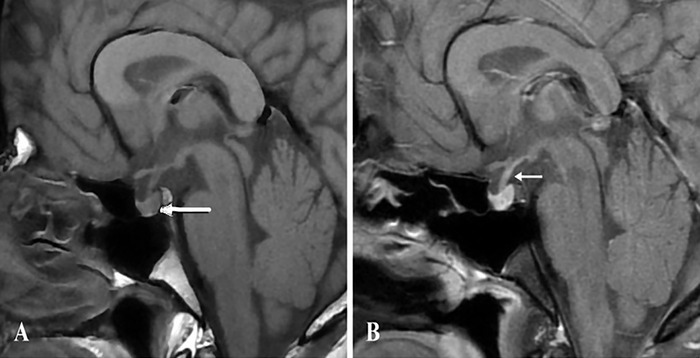 Idiopathic Arginine Vasopressin Deficiency With Mild and Reversible Hypercalcemia.
