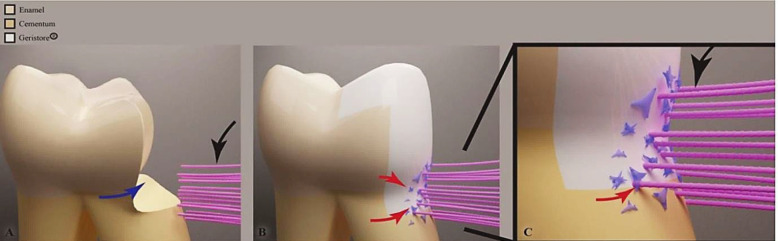 A Critical Review of the Role of Geristore® in Contemporary Endodontics.