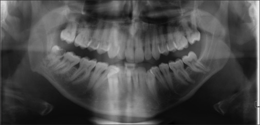 Three-dimensional reconstruction of cone beam CT scan in the planning of the surgery of mandibular impacted third molars.