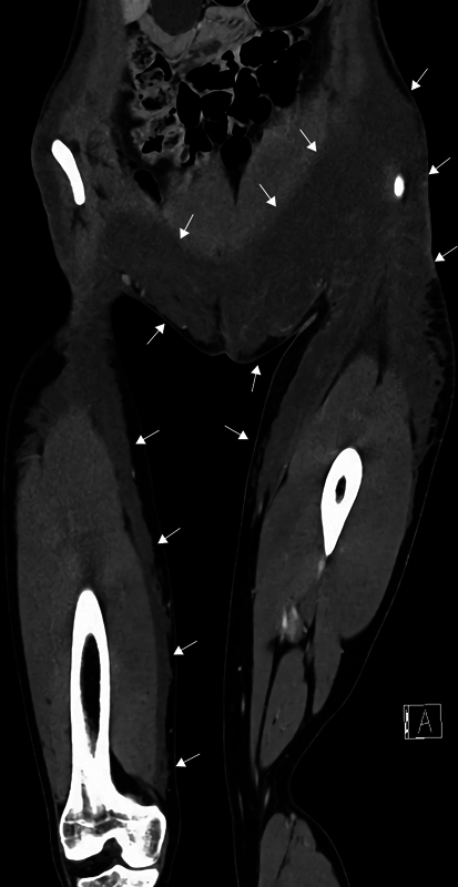 Aquafilling Filler for Buttock Augmentation Cause Severe Long-Term Complications: A Case Report.