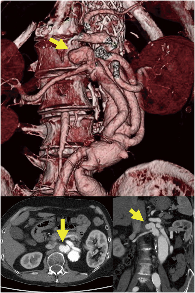 Renal Artery Stent-Graft Implantation Using the Retrograde Approach in a Patient Who Developed a Renal Artery Aneurysm after Thoracoabdominal Aortic Repair.