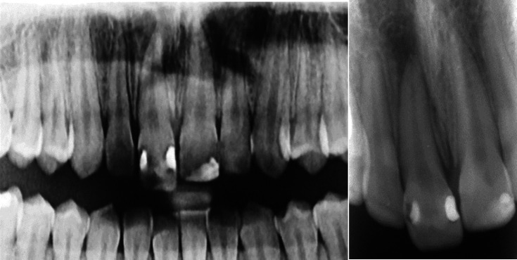 Management of Acute Apical Abscess Presenting with Rapid Extrusion of a Tooth: A Case Report.