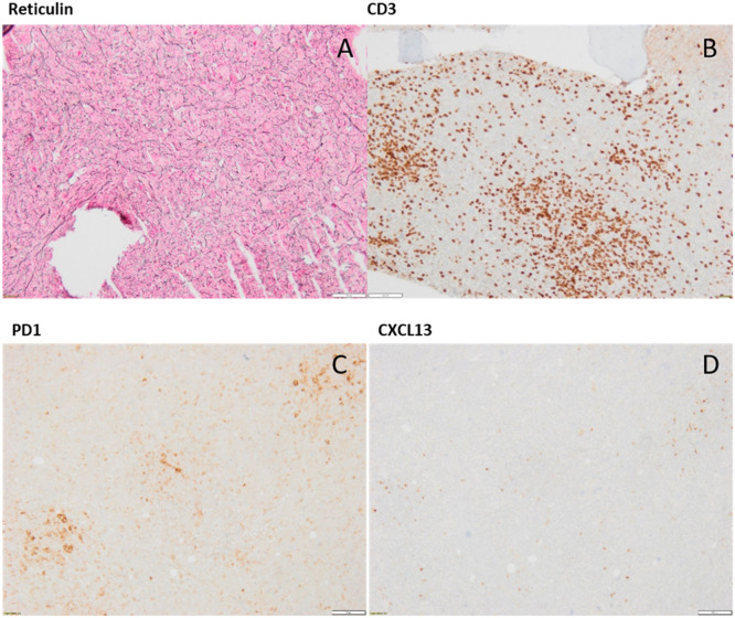 When the mask slips: A peripheral T-cell lymphoma disguised as lupus with myelofibrosis in a patient with May-Hegglin syndrome