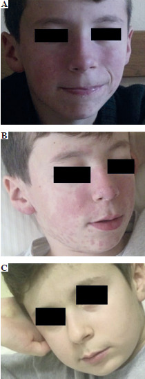 Anifrolumab in the treatment of recurrent systemic lupus erythematosus: the first post-trial case report.