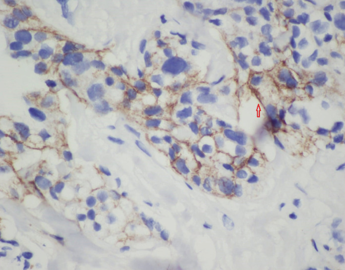Carbonic Anhydrase IX Enzyme in Triple Negative Breast Carcinoma: Relationship With Prognostic Factors and Response to Neoadjuvant Chemotherapy.