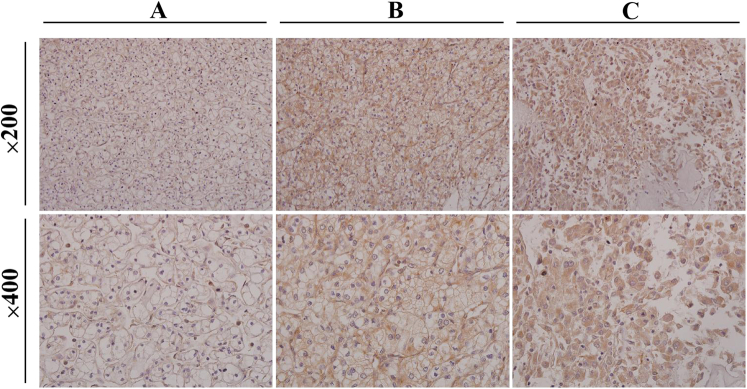 Low Expression of Mitochondrial Ribosomal Protein S5 is Associated With Poor Prognosis in Patients With Clear Cell Renal Cell Carcinoma.