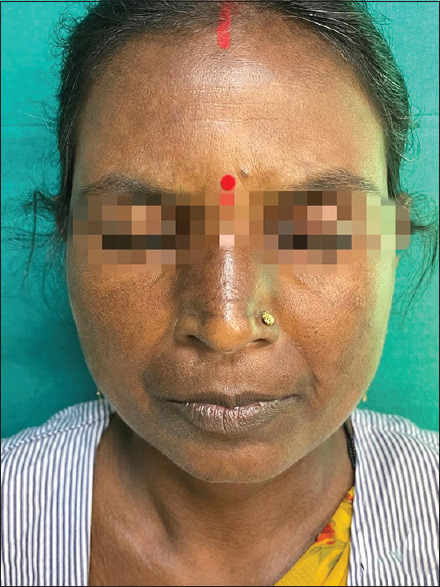 Efficacy of rituximab in treating systemic sclerosis in HIV-positive patients: A novel case report.