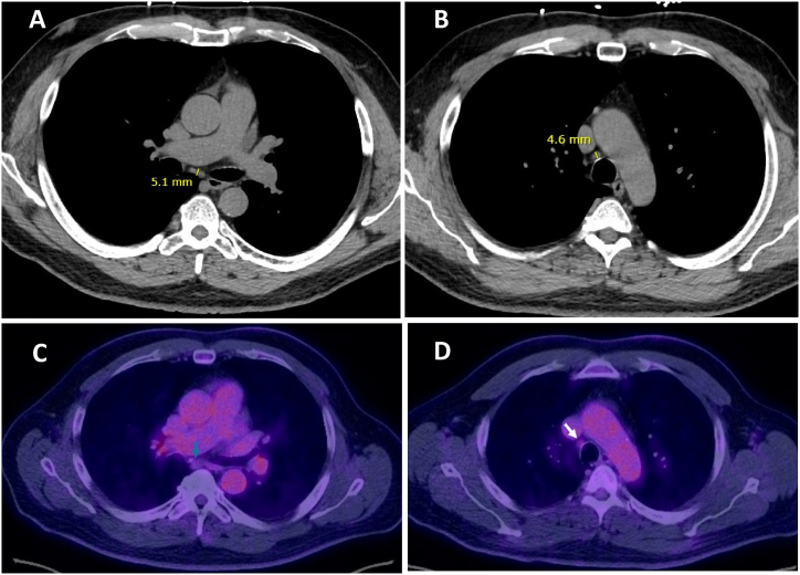 A case report: Endobronchial ultrasound guided biopsy of radiographically normal size thoracic lymph nodes supporting diagnosis of cardiac sarcoidosis