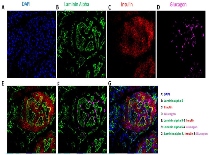 Correlation of Pancreatic Laminin Alpha 5 Expression With Clinical Outcomes in Total Pancreatectomy With Islet Autotransplantation.
