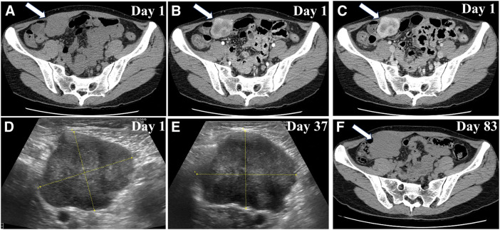 A Case of Inflammatory Myofibroblastic Tumor in the Abdominal Wall with Anaplastic Lymphoma Kinase and Whole Exome Sequencing Analysis.