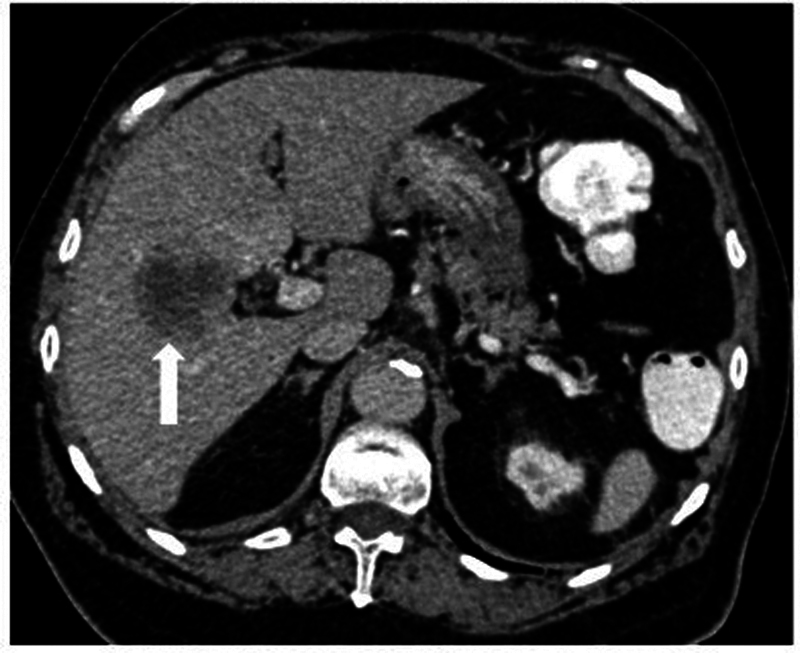 CT and MR Imaging in Colorectal Carcinoma: A Tool for Diagnosis, Staging, Response Evaluation, and Follow-Up.