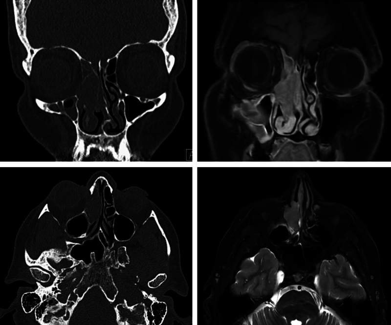 HPV-associated Sinonasal Squamous Cell Carcinoma.
