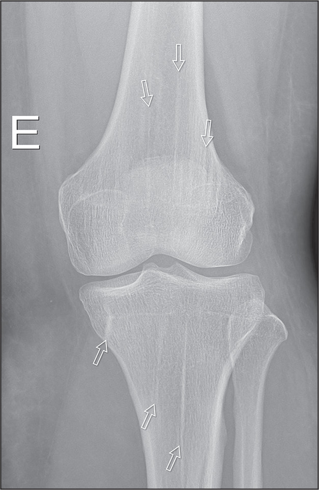 Sclerosing bone dysplasias: a pictorial essay.
