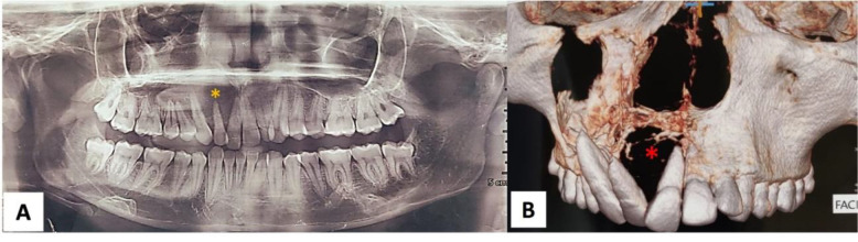 Unusual Maxillary Swelling in a 21-Year-Old Male - A Case Report.