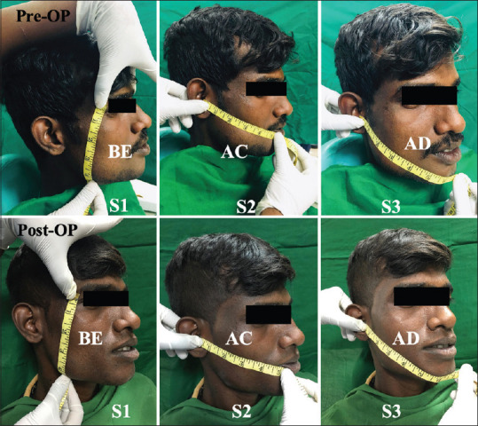 Gender Difference in Pain Perception and Post-surgery Satisfaction Following Impacted Mandibular Third Molar Surgery - A Comparative Study.