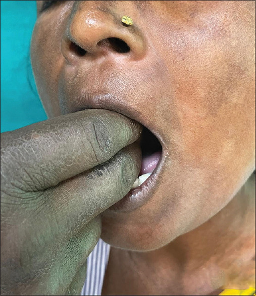 Efficacy of rituximab in treating systemic sclerosis in HIV-positive patients: A novel case report.