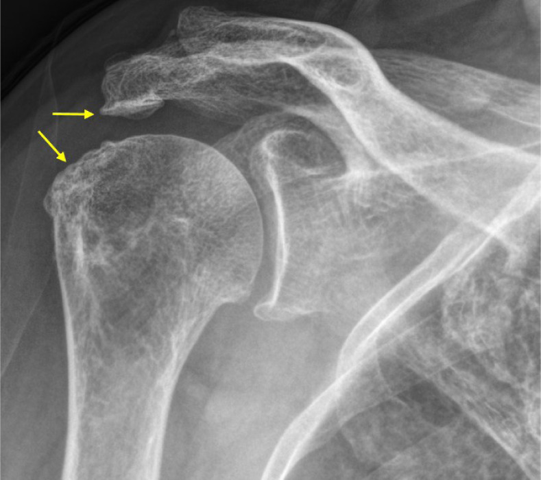 Conservative treatment of older adult patients with shoulder diseases: a narrative review.