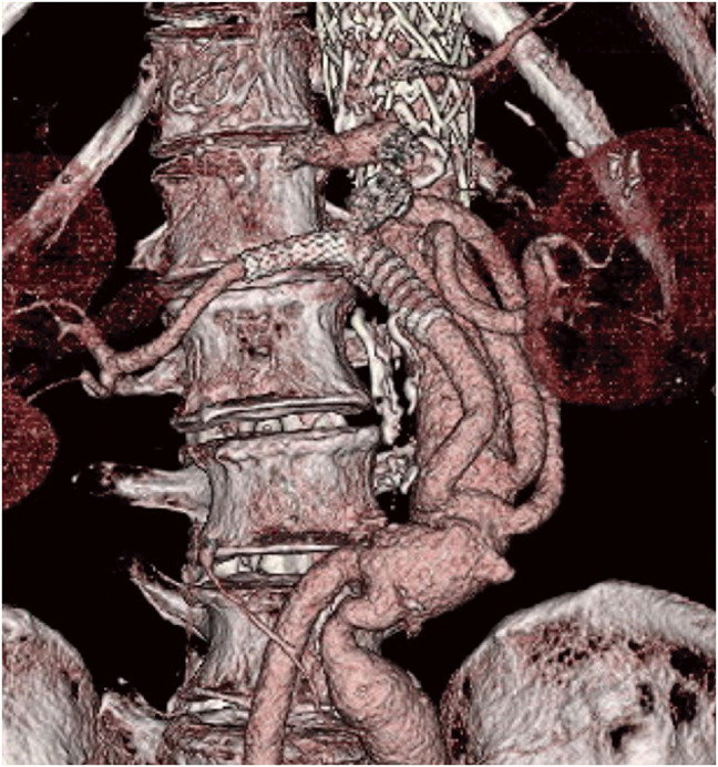 Renal Artery Stent-Graft Implantation Using the Retrograde Approach in a Patient Who Developed a Renal Artery Aneurysm after Thoracoabdominal Aortic Repair.