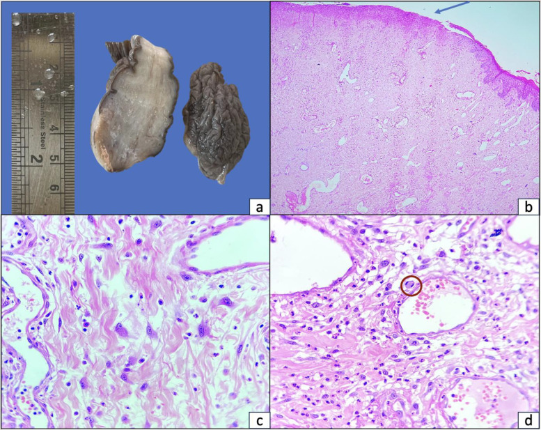 An Intriguing Case of Rapidly Growing Vulval Fibroepithelial Polyp: Awareness of Histologic Mimickers is Crucial.