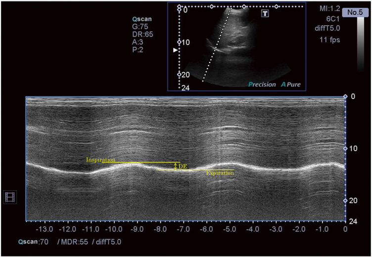 Measuring Tidal Volume with Diaphragm Movement and Chest Circumference.