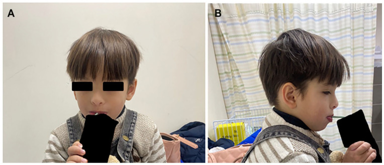 A Case of Rafiq Syndrome (MAN1B1-CDG) in a Palestinian Child, With Brief Literature Review of 44 Cases.