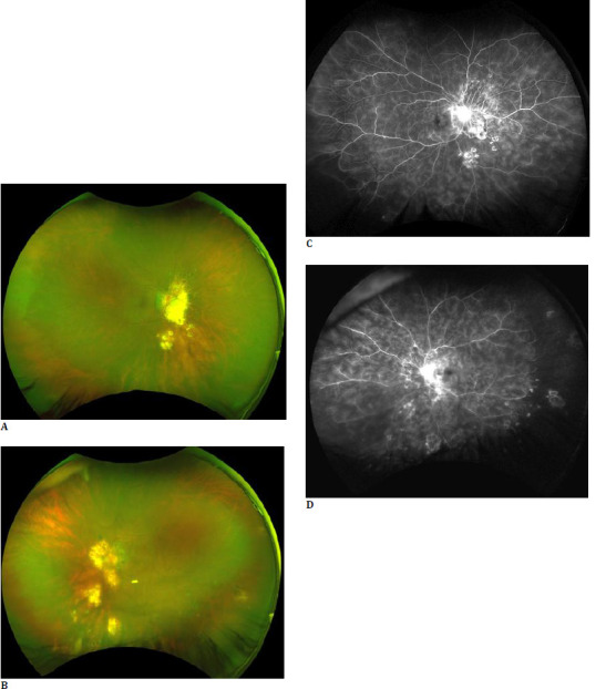 Fern-Like Pattern on Ultra-Widefield Fluorescein Angiography Across Various Uveitic Conditions.