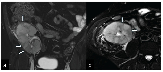 Factor V Leiden Heterozygous Mutation and Hyperhomocysteinemia Presenting with Vascular Rejection and Renal Allograft Infarction.