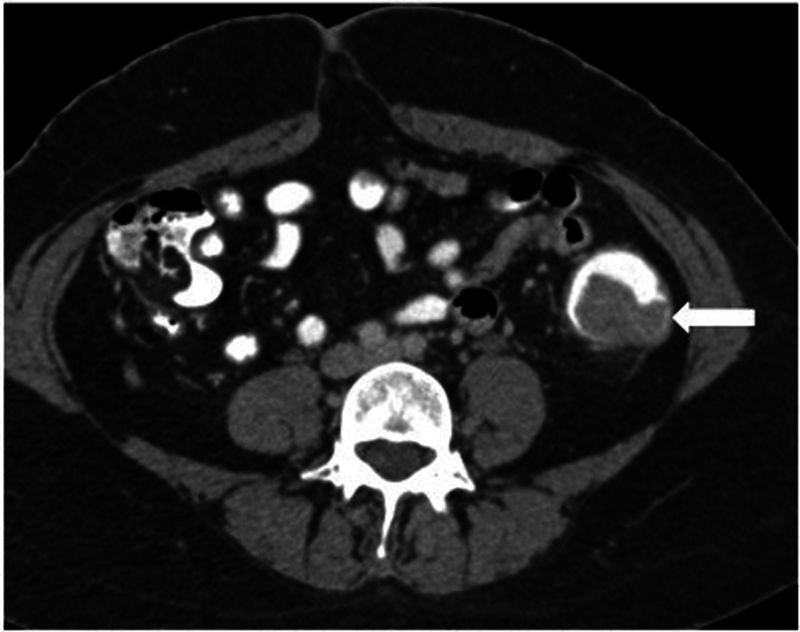 CT and MR Imaging in Colorectal Carcinoma: A Tool for Diagnosis, Staging, Response Evaluation, and Follow-Up.