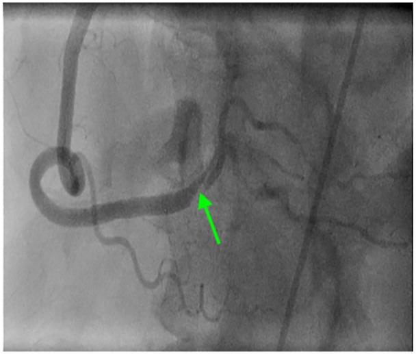 Premature Coronary Artery Disease Presenting as STEMI in a Teenager.