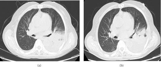 A Case Report of <i>Chlamydia psittaci</i> Infective Endocarditis Complicated With Pneumonia.