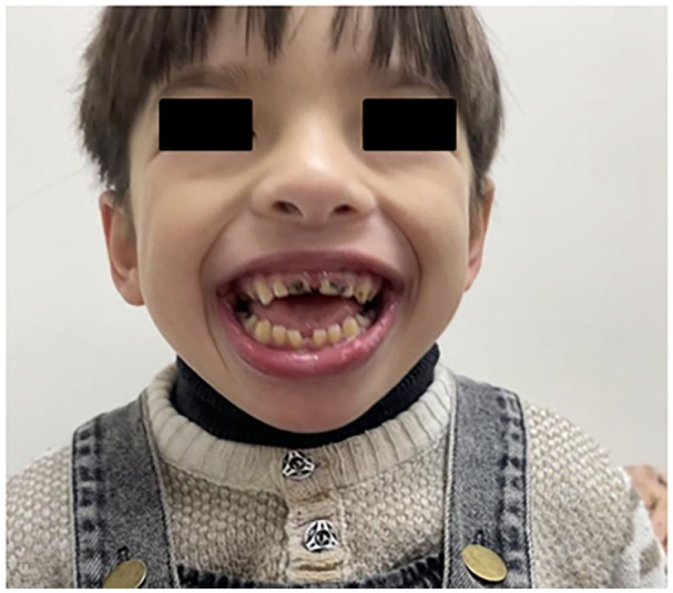 A Case of Rafiq Syndrome (MAN1B1-CDG) in a Palestinian Child, With Brief Literature Review of 44 Cases.