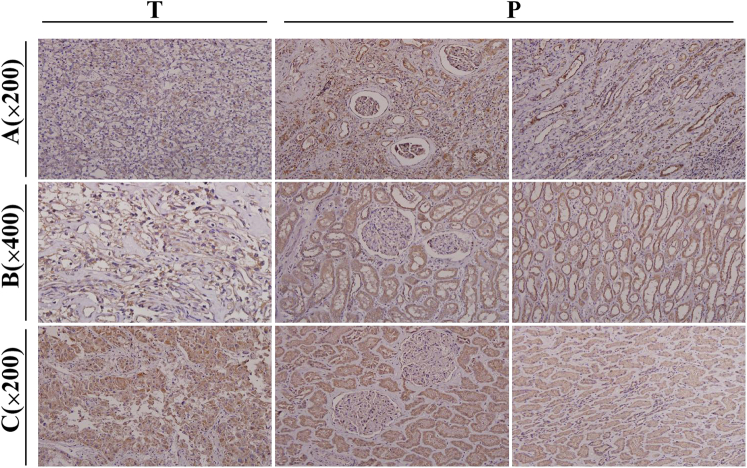 Low Expression of Mitochondrial Ribosomal Protein S5 is Associated With Poor Prognosis in Patients With Clear Cell Renal Cell Carcinoma.