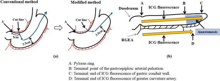 Modification of the lesser curvature incision line enhanced gastric conduit perfusion as determined by indocyanine green fluorescence imaging and decreased the incidence of anastomotic leakage following esophagectomy.