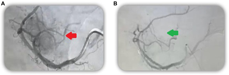 Successful Treatment of Benign Insulinoma by Transcatheter Angioembolization