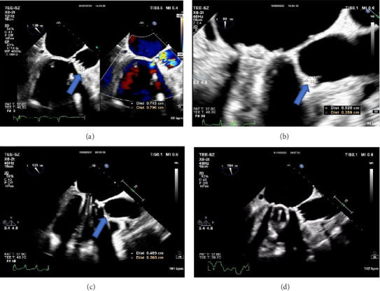 A Case Report of <i>Chlamydia psittaci</i> Infective Endocarditis Complicated With Pneumonia.