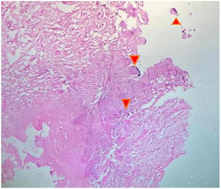 A Rare Case of Calciphylaxis: A Case Report.