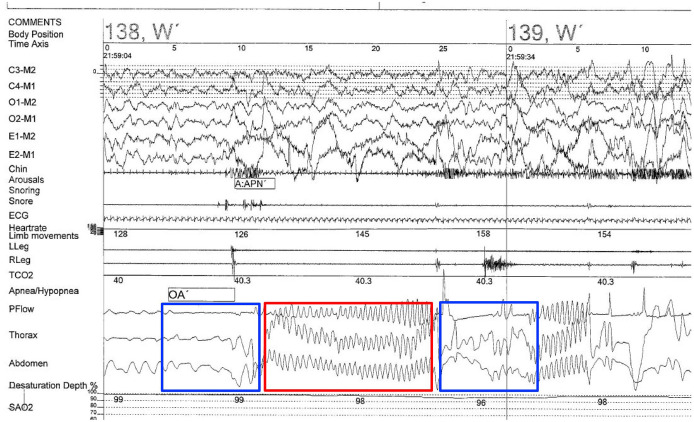 Sleep and breathing in children with Joubert syndrome and a review of other rare congenital hindbrain malformations.