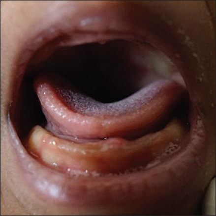 Diagnosis and Management of Natal Tooth Secondary to Beckwith-Wiedemann Syndrome in a 25-day-old Infant: A Rare Case Report.