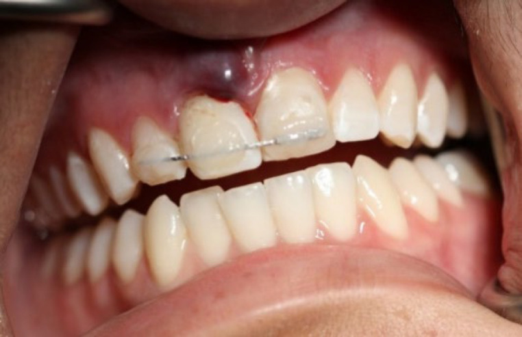Management of Acute Apical Abscess Presenting with Rapid Extrusion of a Tooth: A Case Report.