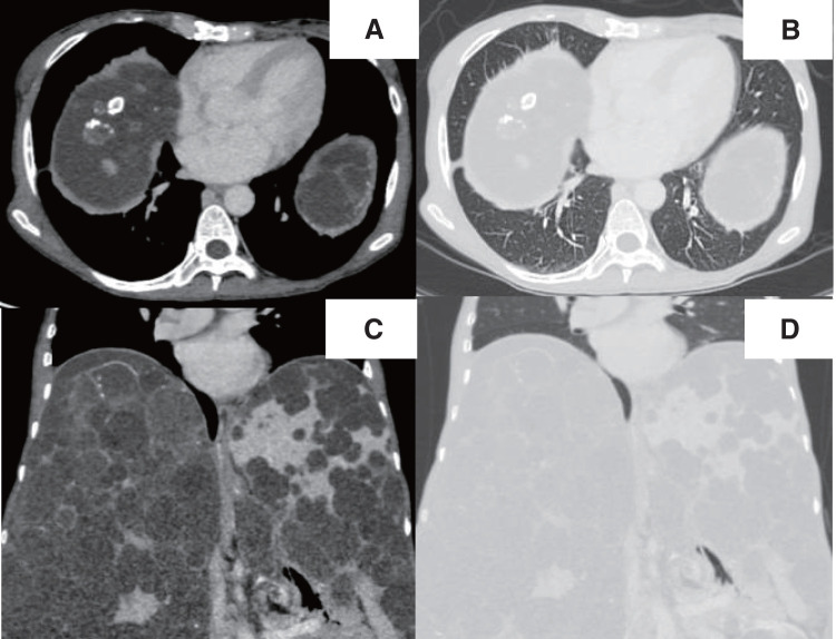 Pneumatocele Development after Deceased-Donor Liver Transplantation for Multiple Hepatic Cysts due to Autosomal Dominant Polycystic Kidney Disease: A Case Report.