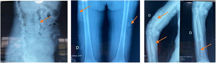 A Rare Case of Calciphylaxis: A Case Report.