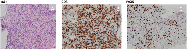 When the mask slips: A peripheral T-cell lymphoma disguised as lupus with myelofibrosis in a patient with May-Hegglin syndrome